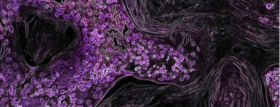 Image of lung cancer
